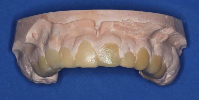 A very quick and rough wax-up to fabricate temporary crowns. Temporary crowns must be fabricated when the braces come off to prevent movement of the teeth.