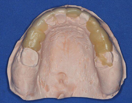 Occlusal view of quick wax up.