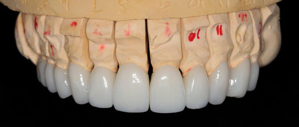 Upper final porcelain crowns on master cast (frontal view).