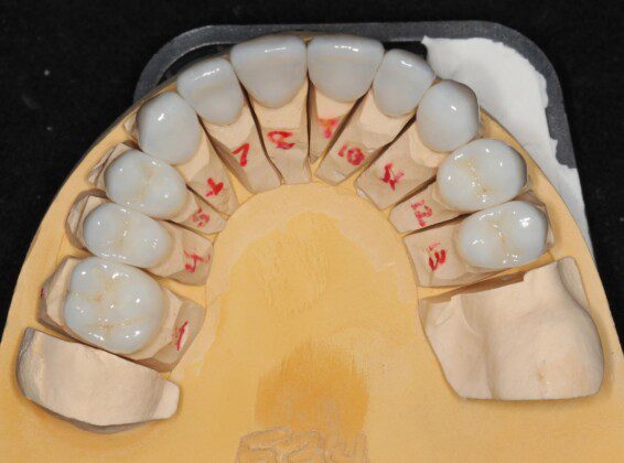 Upper final porcelain crowns on master cast (occlusal view).