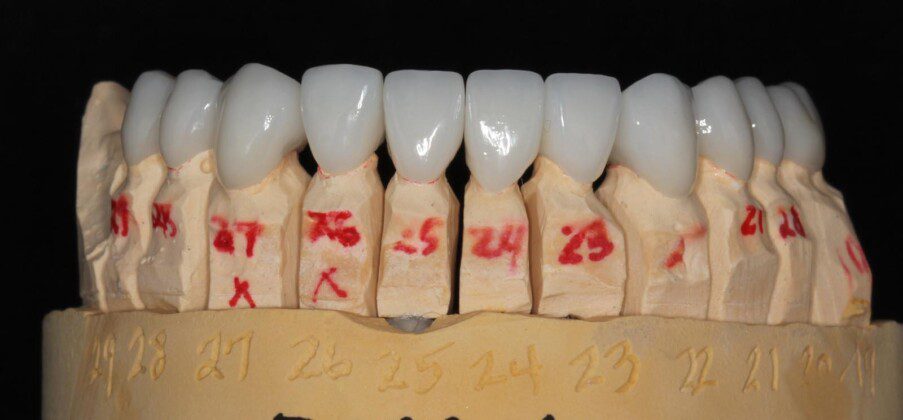 Lower final porcelain crowns on master cast (frontal view).