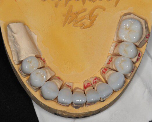 Lower final porcelain crowns on master cast (occlusal view).