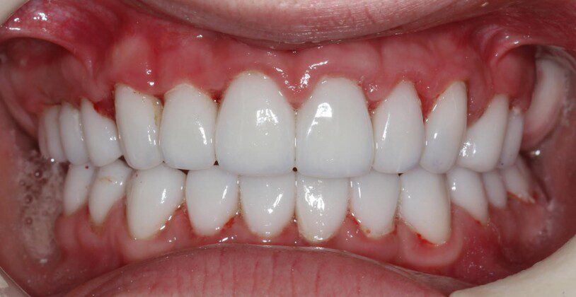 Crowns in place, day of delivery. We had great difficulty getting this patient to properly clean her teeth. After many years of being ashamed of her teeth, she had little motivation to clean them. Wait until you see her gums after her new crowns!