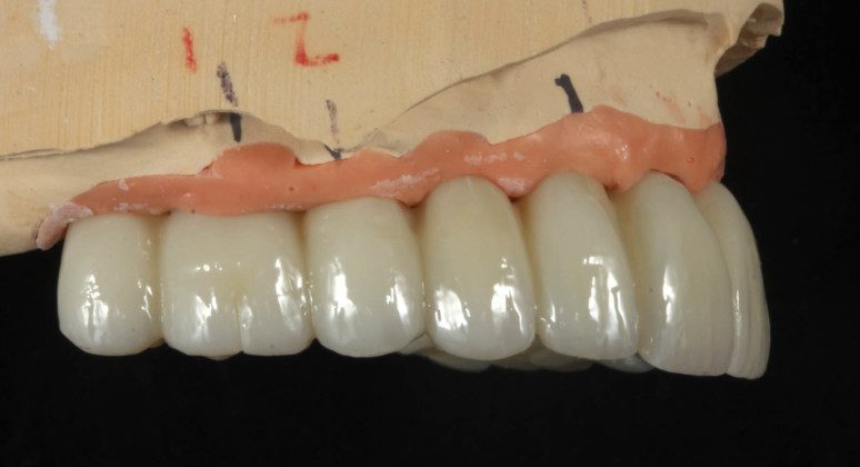 Right side view, implant bridge.