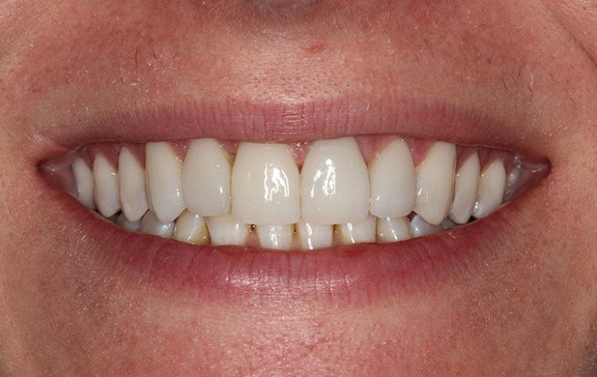 Smile restored with porcelain veneers