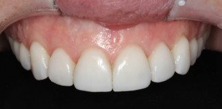 Lips-retracted view of upper front teeth with beautiful porcelain veneers