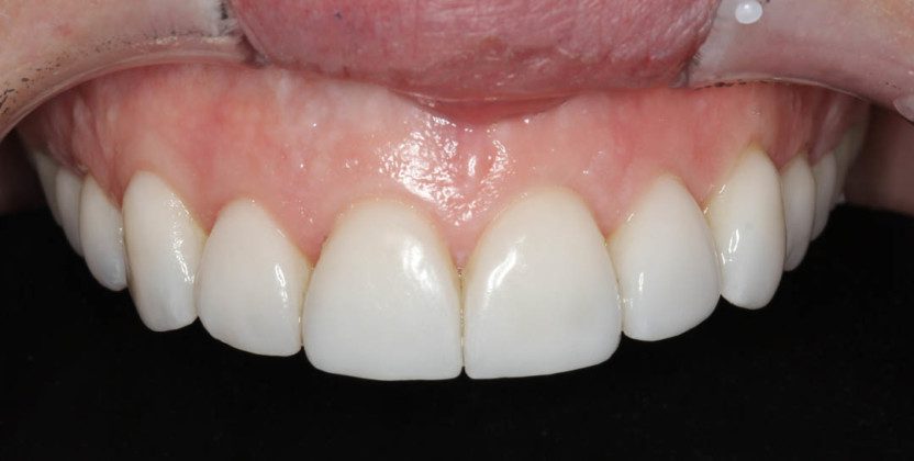 Lips-retracted view of upper front teeth with beautiful porcelain veneers