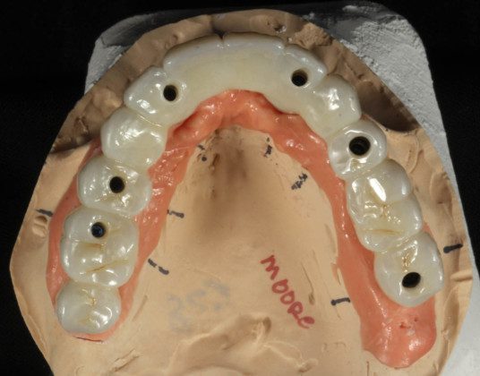Occlusal view, implant bridge. Note the screw holes for the prosthetic screws.