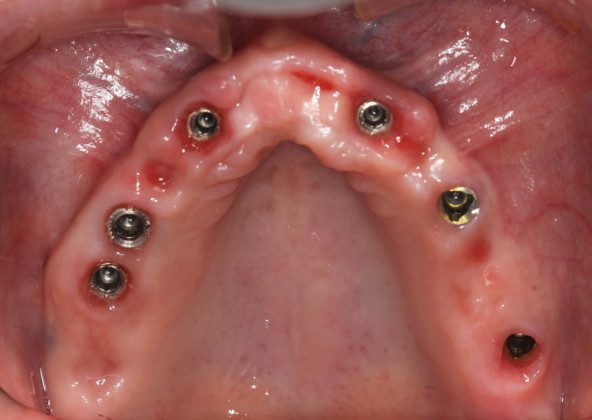 Occlusal view of implants in mouth. The gum tissues have matured very nicely and are ideal recipient sites for the zirconium bridge.