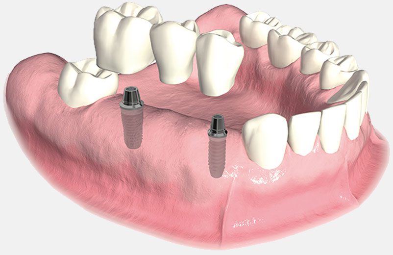 Fixed Implant Bridges (non-removable) - Dental Implant Center
