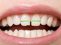 "Dangers of DIY dentistry, orthodontics, rubber bands on teeth"