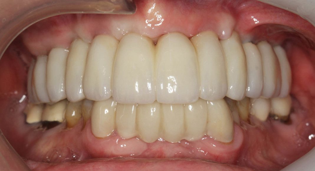 Frontal view with teeth together (in occlusion).