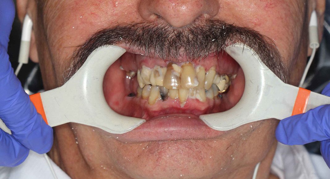 Pre-op, frontal full-face smile, lips retracted.