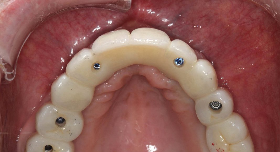 Occlusal view, day of delivery. If you look closely, you can see the final prosthetic screw (blue). This channel is covered with composite resin and patient comfort.