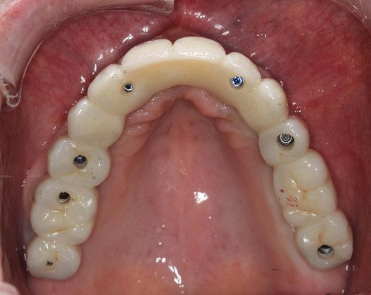 Occlusal view, day of delivery. If you look closely, you can see the final prosthetic screw (blue). This channel is covered with composite resin and patient comfort.