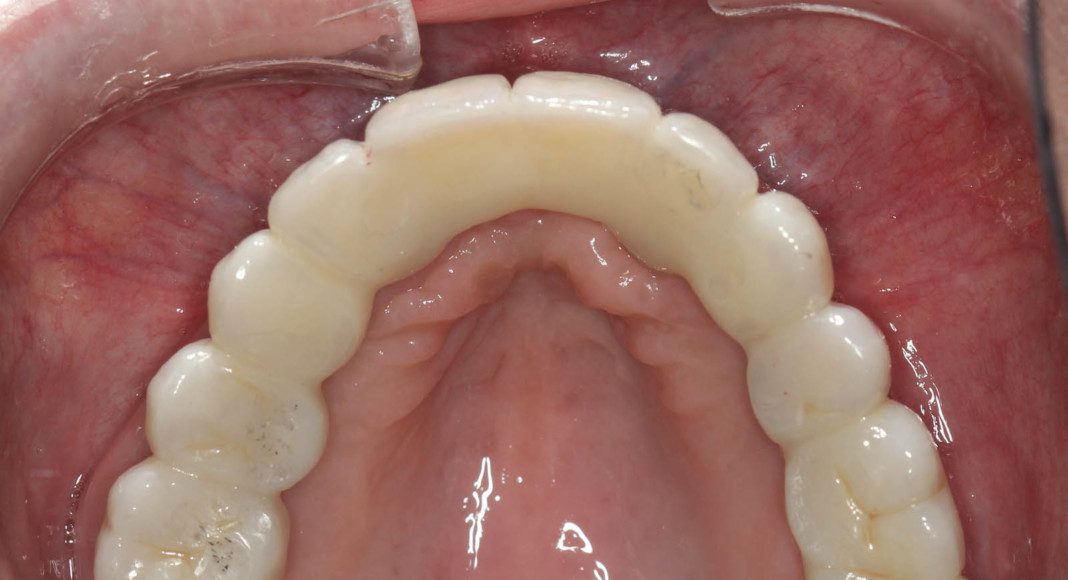 Occlusal view of final, zirconia bridge with screw holes covered with composite resin.