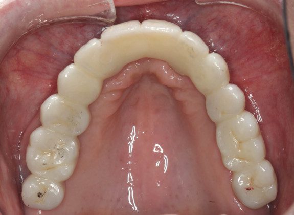 Occlusal view of final, zirconia bridge with screw holes covered with composite resin.