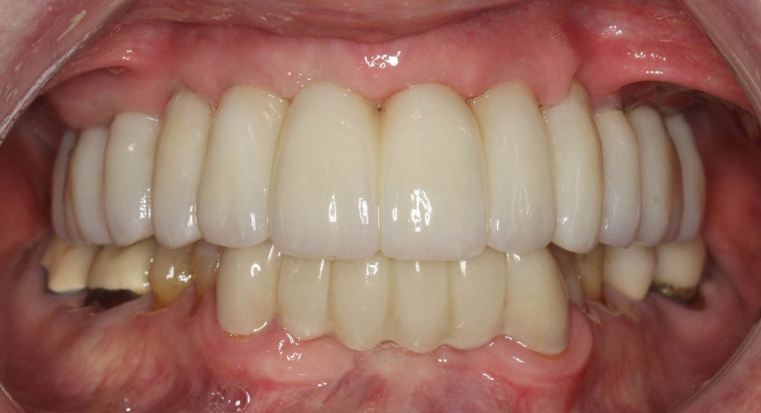 Lips retracted, frontal view of new bridge.