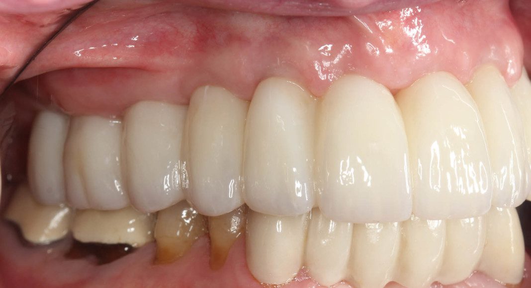 Right lateral (mirror) view of bridge. Note the &ldquo;normal&rdquo; contours that mimic natural teeth.