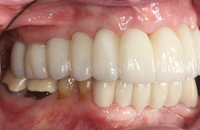 Right lateral (mirror) view of bridge. Note the “normal” contours that mimic natural teeth.