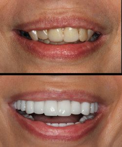 “Procedures done by prosthodontists, smile makeover, before, crooked, yellow, damages, after, white, symmetrical and perfect"