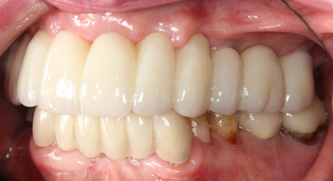 Left lateral (mirror) view of bridge. Note the &ldquo;normal&rdquo; contours that mimic natural teeth.