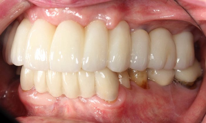 Left lateral (mirror) view of bridge. Note the “normal” contours that mimic natural teeth.
