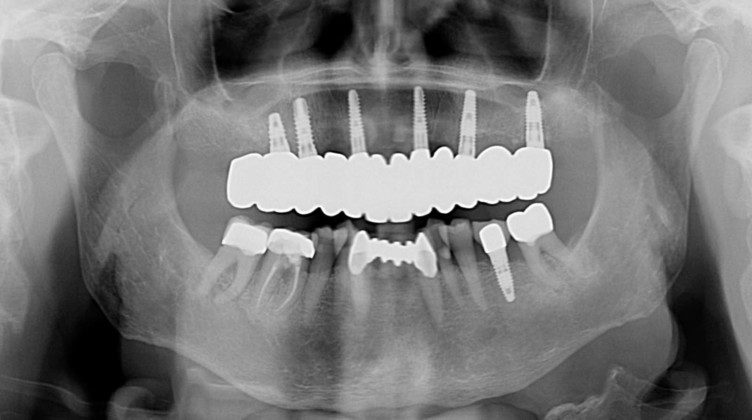 Post-treatment panoramic x-ray. Note: no angled implants or abutments. Implants are placed where the roots of teeth were. Prosthesis is easily cleaned.