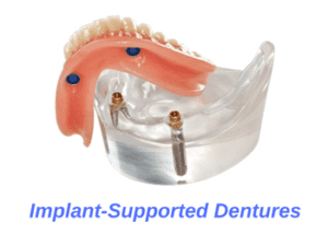 "Implant supported denture, 2 implants and snaps underneath that snap on and off of the implants"