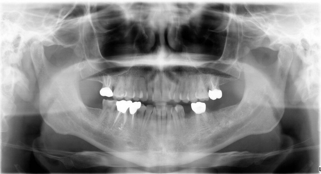 Pre-op panoramic radiograph