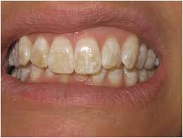 "Ways medications can harm your teeth, Discoloration, Stains, Increased tartar buildup"