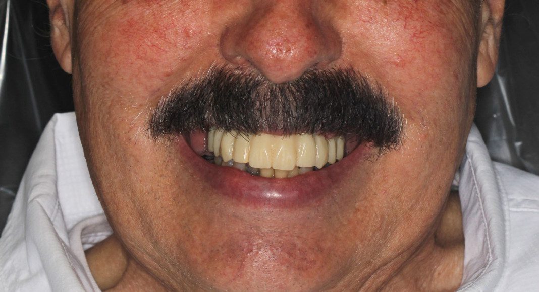 Two-months, full face, frontal view.