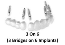 3 On 6 Dental Implants: Why We Don’t Do Them 3 on 6 bridges diagram of parts