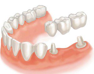 “Procedures done by prosthodontists, bridges"