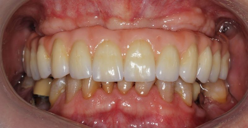Fixed Implant Dentures/All On 4/Hybrid