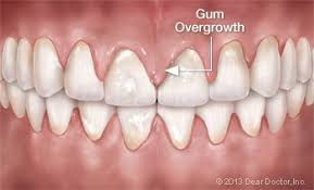 "Ways medications can harm your teeth, gum tissue overgrowth"