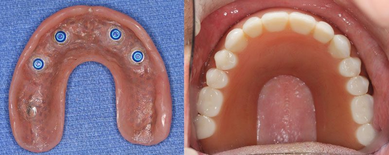 Removable Implant Dentures/Overdentures