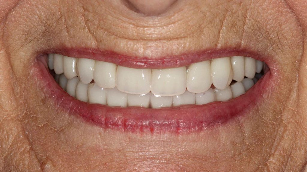Complete Upper Denture Lower – Mini - Implant Overdenture - 2 implants