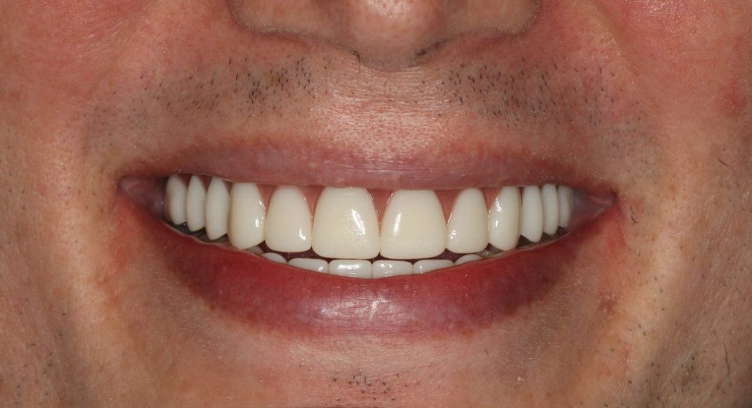 Upper and Lower Implant Overdentures 9 total implants (Male)