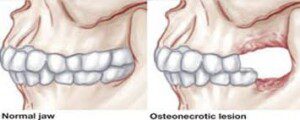 "Ways medications can harm your teeth, osteonecrosis of the jaw"