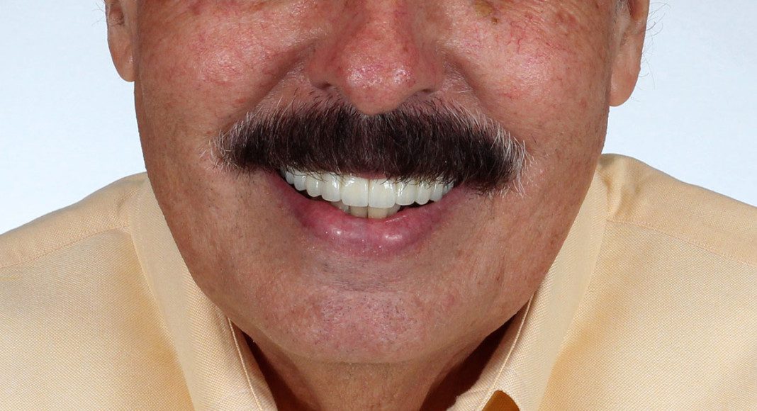 Final, full-face smile. Amazing result and a very happy patient!