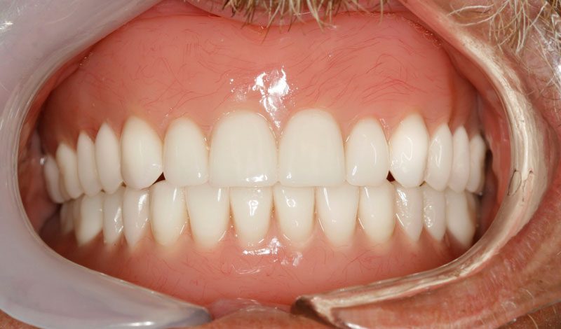 Alternatives to All-On-4, Removable Implant Dentures/Overdentures