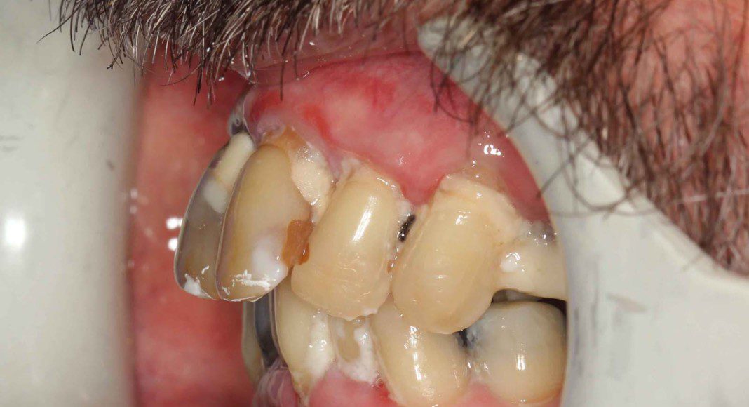 Lips retracted, left lateral view.