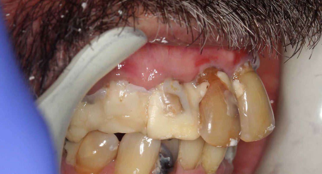 Lips retracted, right lateral view.