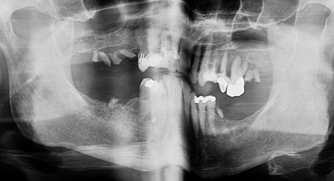 Pre-op panoramic x-ray.