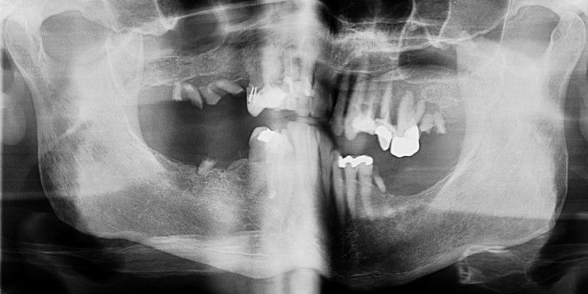 Pre-op panoramic x-ray.