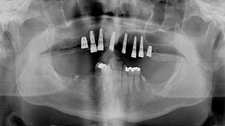 Day of surgery panoramic x-ray. Test implants were placed and adequate insertion torque was obtained (bone density and implant stability measured ≥ 25 Newton-centimeters) which qualifies multiple implants for immediate temporaries. All other teeth were extracted and a total of eight implants placed in the upper jaw (maxilla).