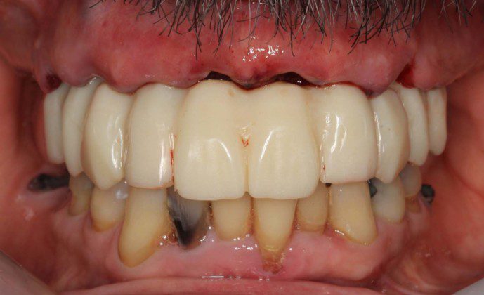 Day of surgery placement of the immediate, fixed temporary bridge on all implants. Not the convex contours to which the tissues can heal, ideally.