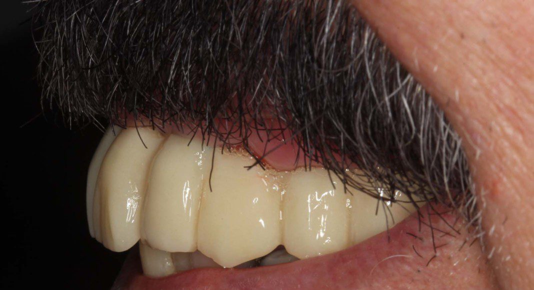 Two-months, left lateral smile view.
