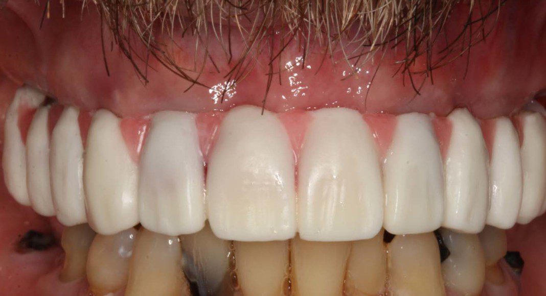 Prototype-wax-up-try-in. Used to determine length, width, overall smile, and bite (lips retracted).